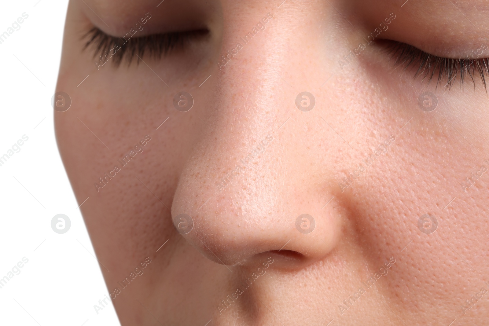 Photo of Young woman with acne problem on white background, closeup view