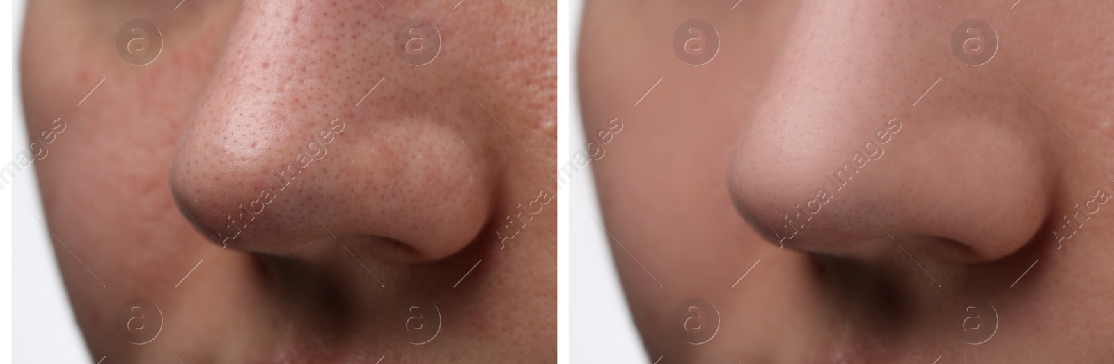 Image of Before and after acne treatment. Photos of woman on white background, closeup. Collage showing affected and healthy skin