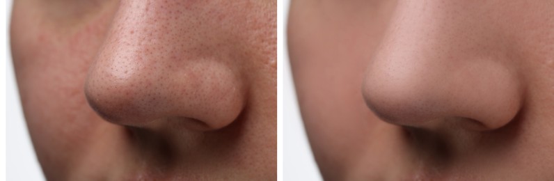 Before and after acne treatment. Photos of woman on white background, closeup. Collage showing affected and healthy skin