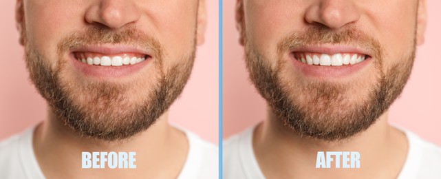 Image of Young man before and after gingivoplasty procedure on beige background, closeup. Banner design