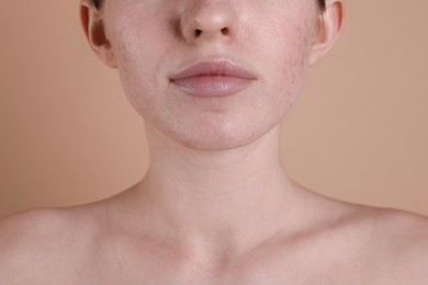 Young woman with acne problem on beige background, closeup