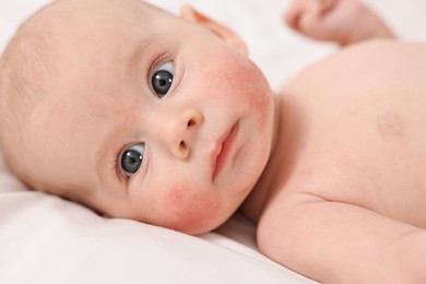 Photo of Cute little baby with allergic redness on cheeks lying on white blanket, closeup