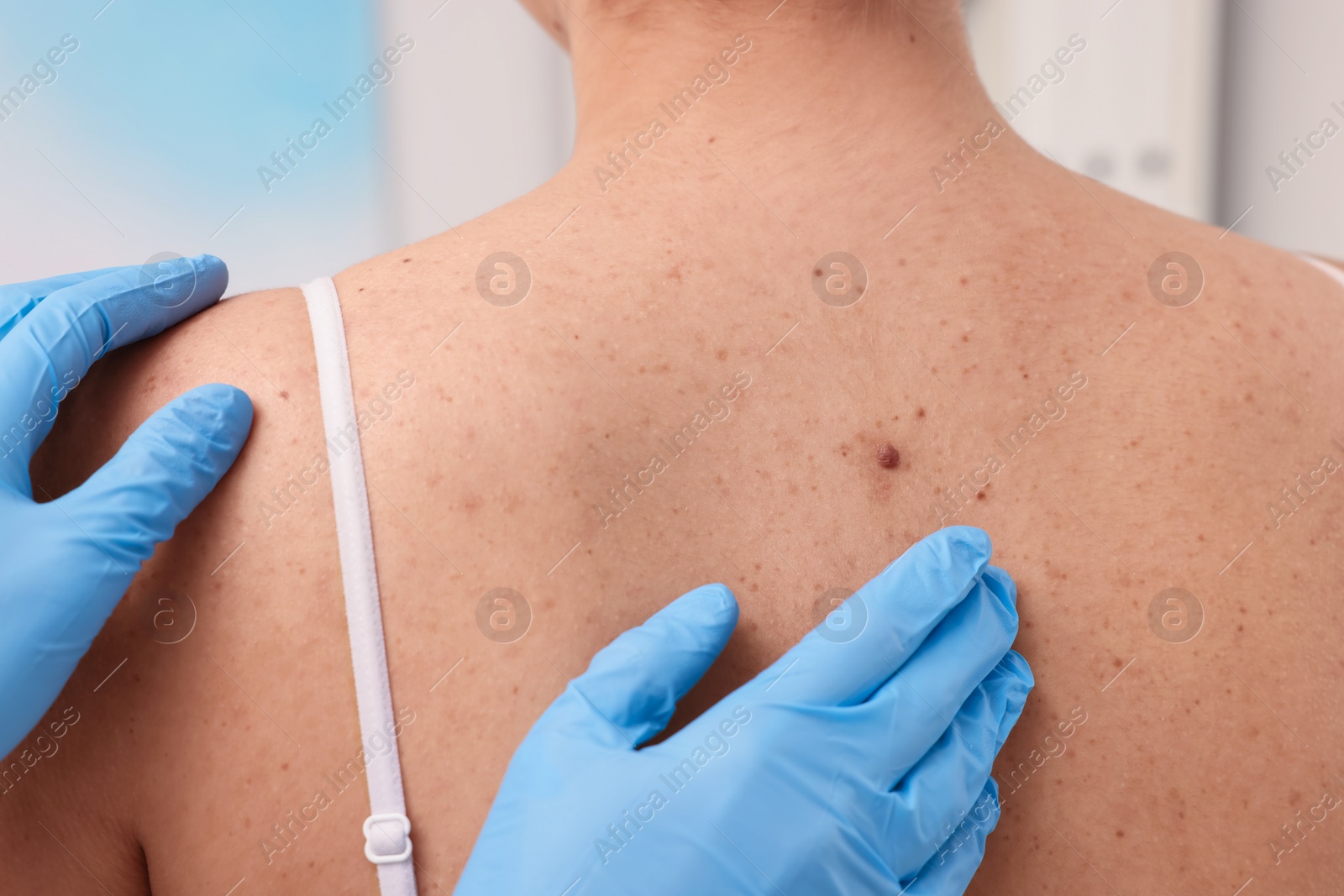 Photo of Dermatologist in rubber glove examining patient's birthmark, closeup view