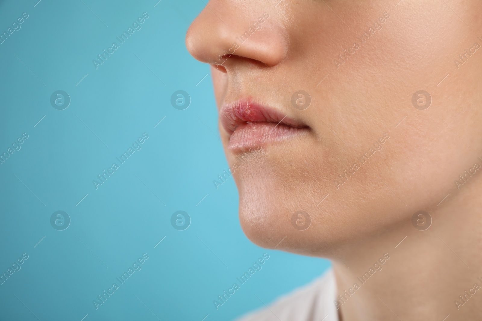 Photo of Woman suffering from herpes on light blue background, closeup. Space for text