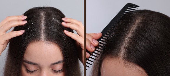 Woman showing hair before and after dandruff treatment on grey background, collage