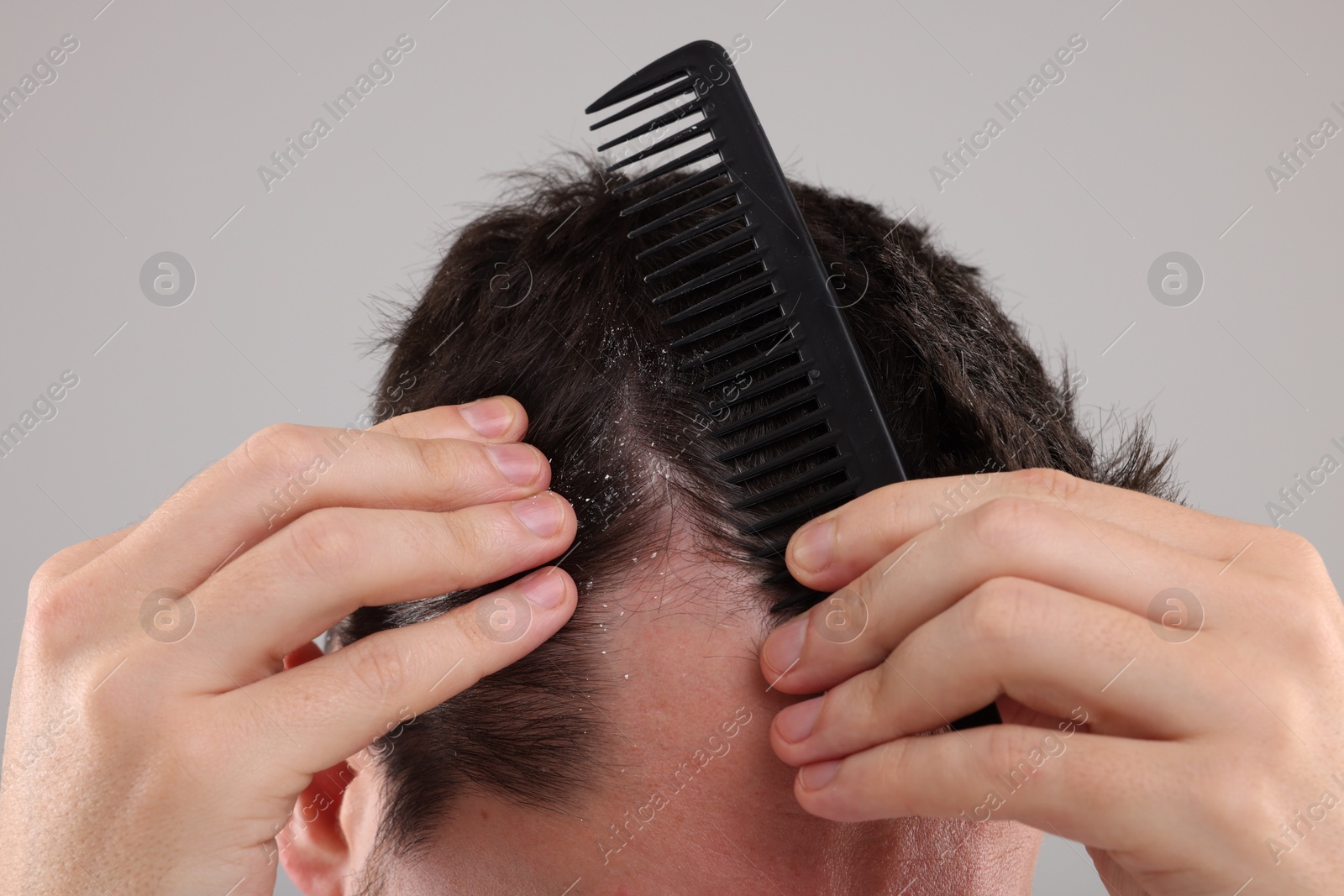 Photo of Dandruff problem. Man with comb examining his hair and scalp on light gray background, closeup
