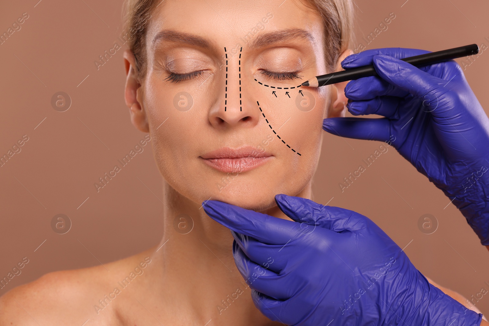 Image of Woman preparing for cosmetic surgery, light brown background. Doctor drawing markings on her face, closeup