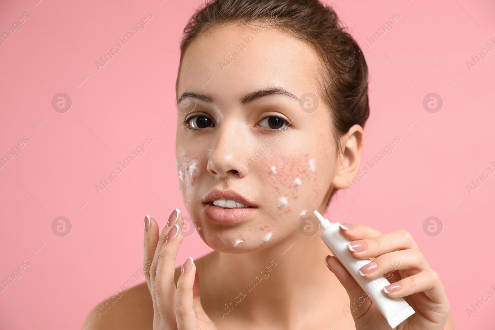 Photo of Teen girl with acne problem applying cream on light pink background