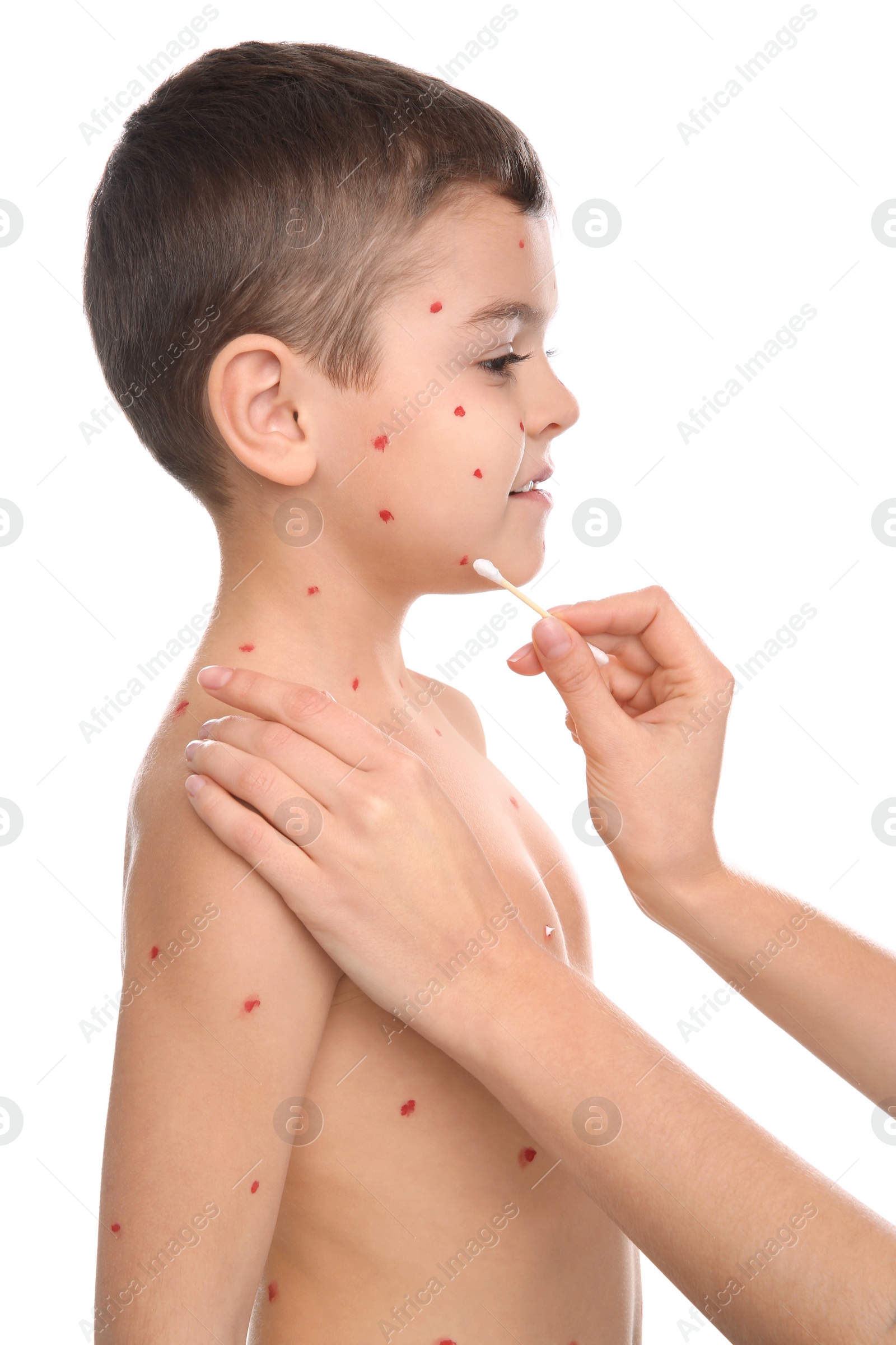 Photo of Woman applying cream onto skin of little boy with chickenpox on white background