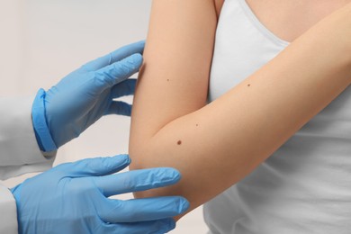 Dermatologist examining patient's birthmark indoors, closeup view