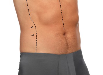 Image of Man with markings for cosmetic surgery on his abdomen against white background, closeup