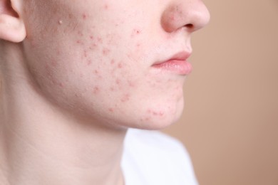 Young man with acne problem on beige background, closeup