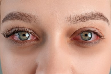 Image of Woman with red eyes suffering from conjunctivitis, closeup