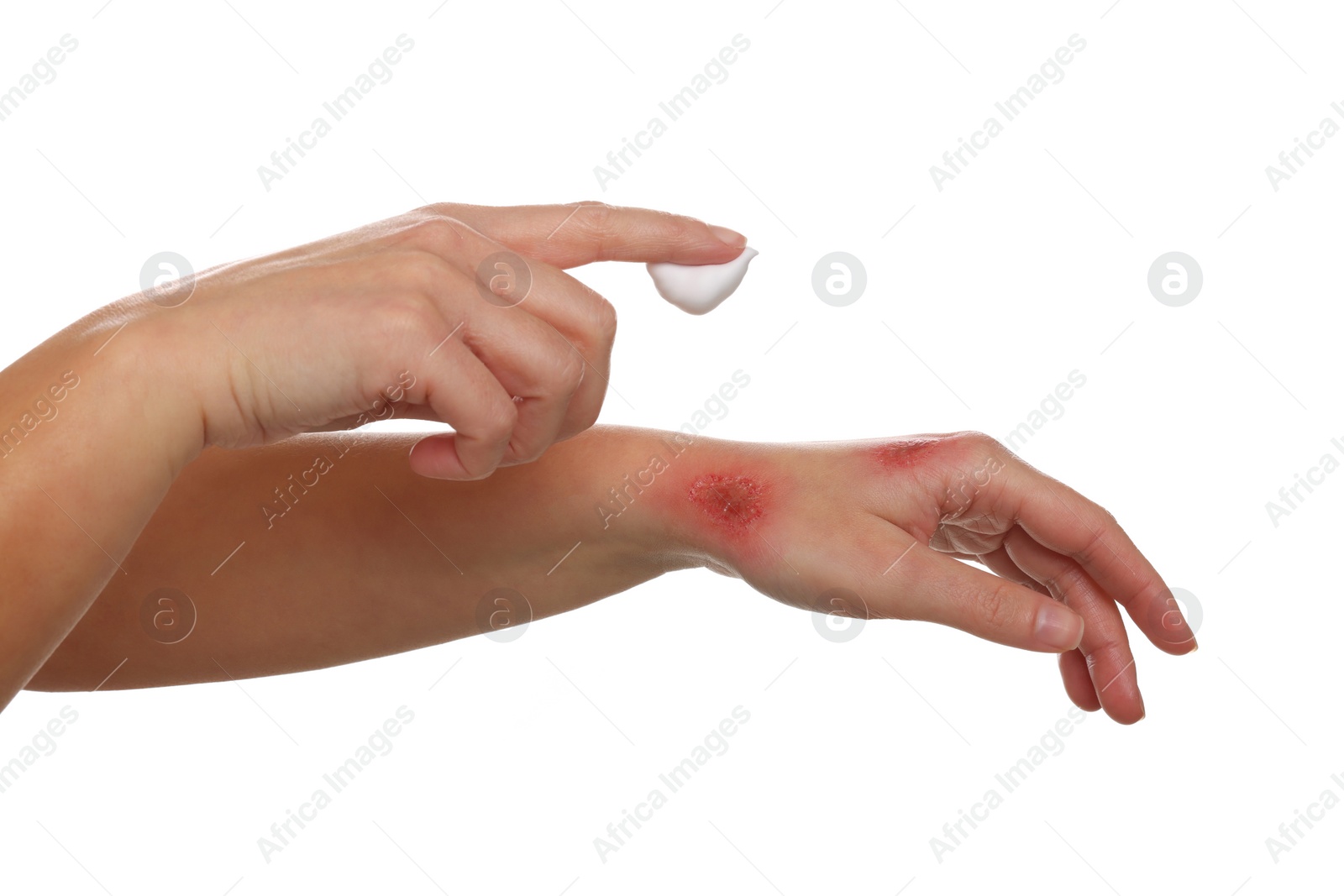 Photo of Woman applying panthenol onto burned hand on white background, closeup