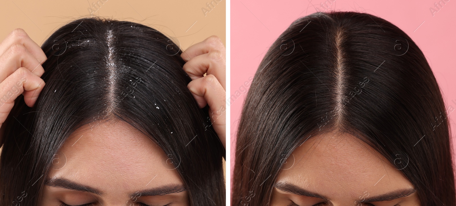 Image of Woman showing hair before and after dandruff treatment on color backgrounds, collage