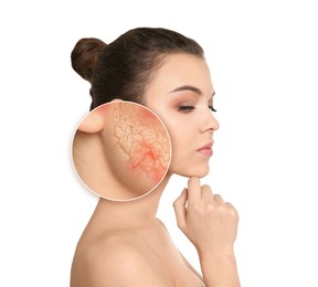Image of Young woman with facial dry skin problem on white background