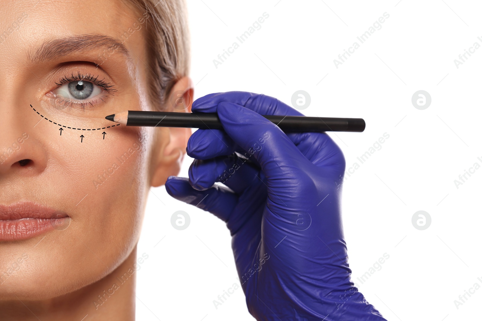 Image of Woman preparing for cosmetic surgery, white background. Doctor drawing markings on her face, closeup