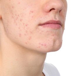 Young man with acne problem isolated on white, closeup