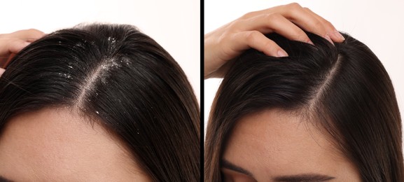 Image of Woman showing hair before and after dandruff treatment on white background, collage