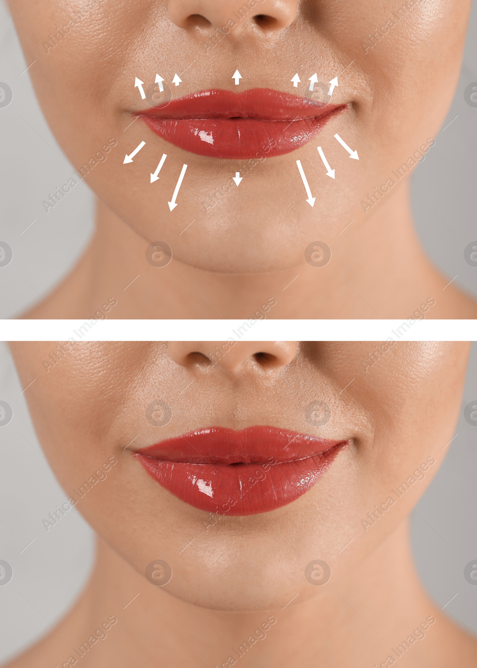 Image of Collage with photos of young woman before and after lips augmentation procedure, closeup