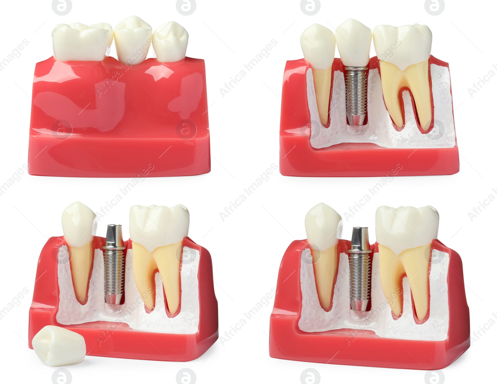 Image of Educational models of gum with dental implant between teeth on white background, collage