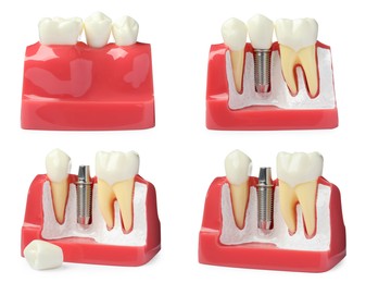 Image of Educational models of gum with dental implant between teeth on white background, collage