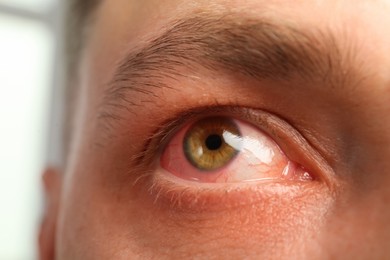 Image of Closeup view of man with inflamed eyes