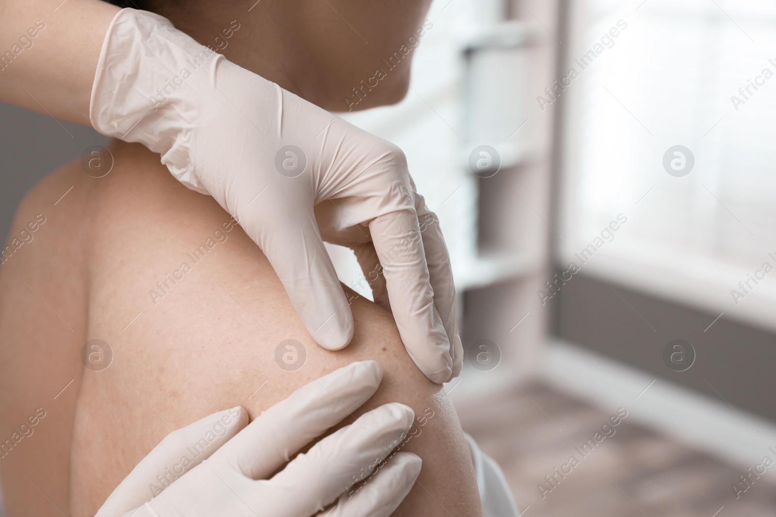 Photo of Dermatologist examining patient's birthmark in clinic, closeup view