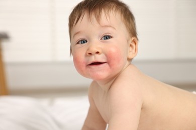 Photo of Cute little baby with allergic redness on cheeks indoors