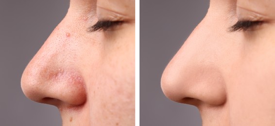 Before and after acne treatment. Photos of woman on grey background, closeup. Collage showing affected and healthy skin