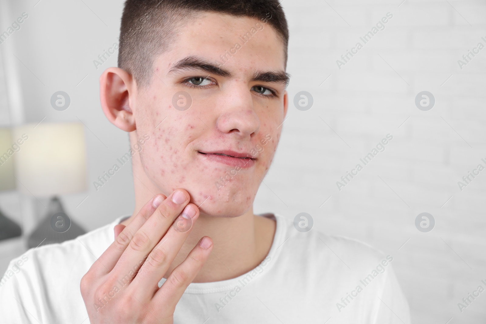 Photo of Young man touching pimple on his face indoors. Acne problem