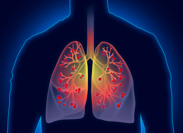 Illustration of Man with diseased lungs on dark background. Illustration
