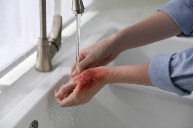 Photo of Woman holding hand with burn under flowing water indoors, closeup